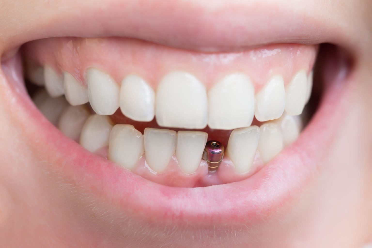 at-what-age-should-a-dental-implant-be-done-healthy-b-daily