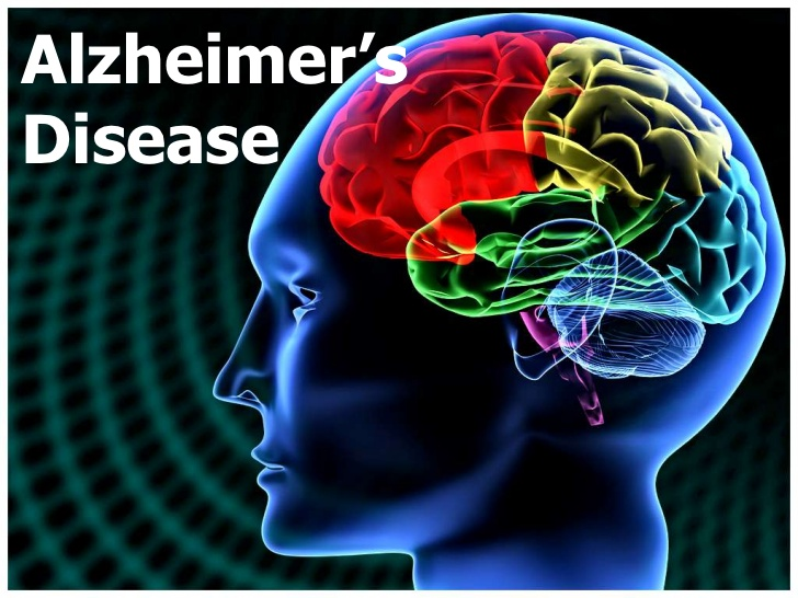 Alzheimer’s Disease | Healthy B Daily