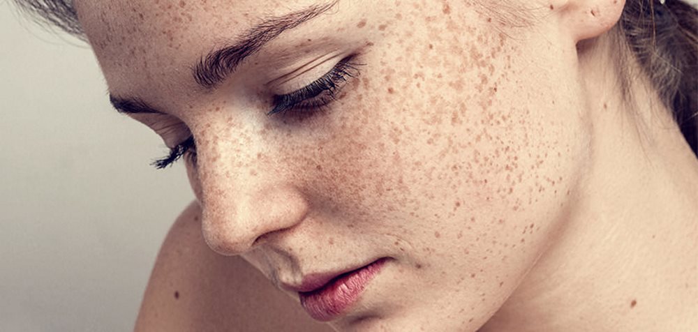 The Best Laser Treatments To Remove Freckles Healthy B Daily